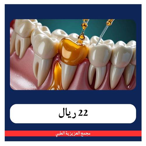عرض الحشوة التجميلية ب 92 ريال - الدفعة الأولى 22 ريال - مجمع العزيزية