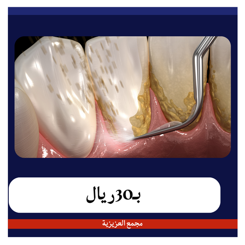 تنظيف الاسنان وازالة الجير بـ70 ريال دفعة أولى 30 ريال مجمع العزيزية