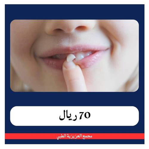 تركيب تاج اي ماكس شامل الكشف و الخطة العلاجية ب 470 ريال - دفعة اولى 70 ريال - مجمع العزيزية