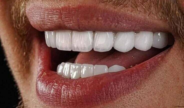 إبتسامة هوليوود 3D