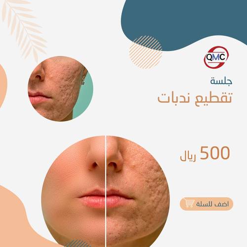 جلسة تقطيع ندبات 