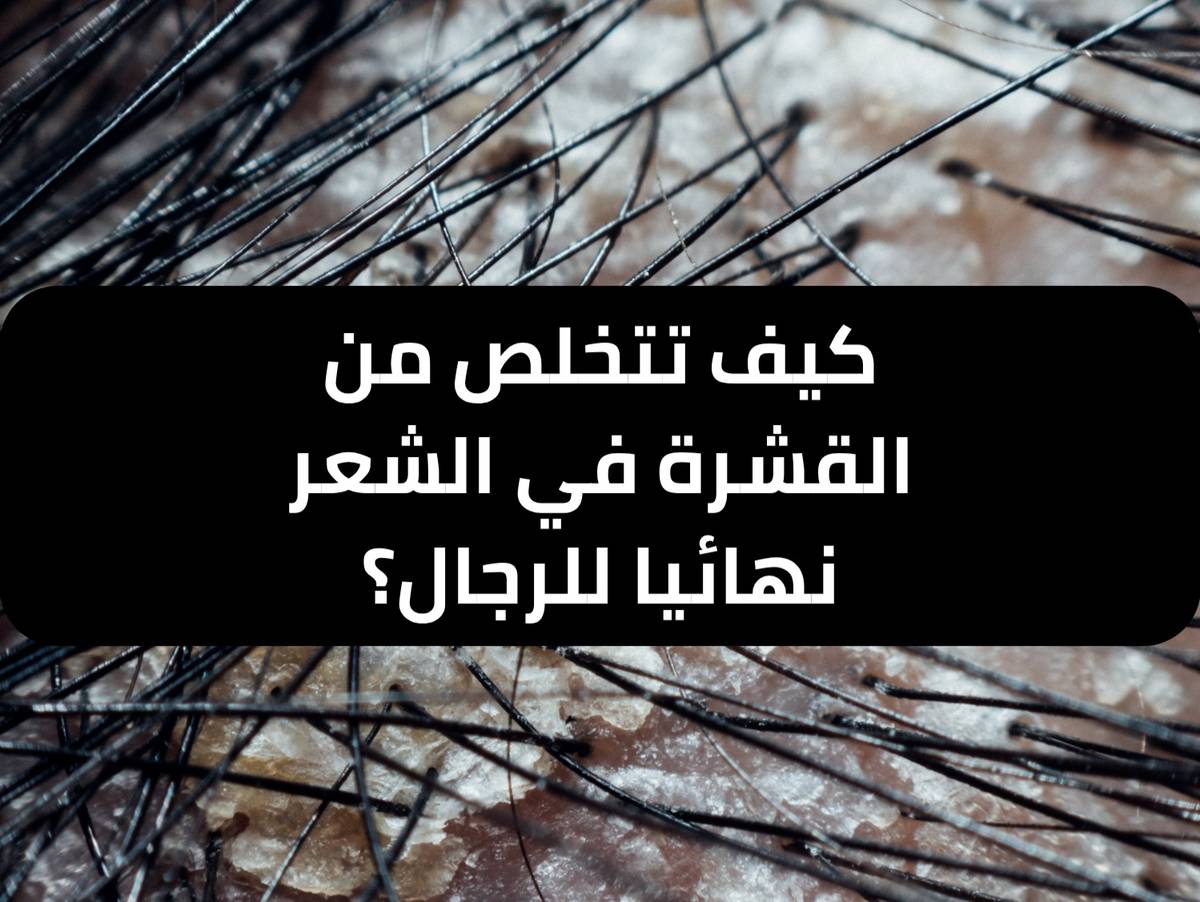 كيف تتخلص من القشرة في الشعر نهائيا للرجال ؟