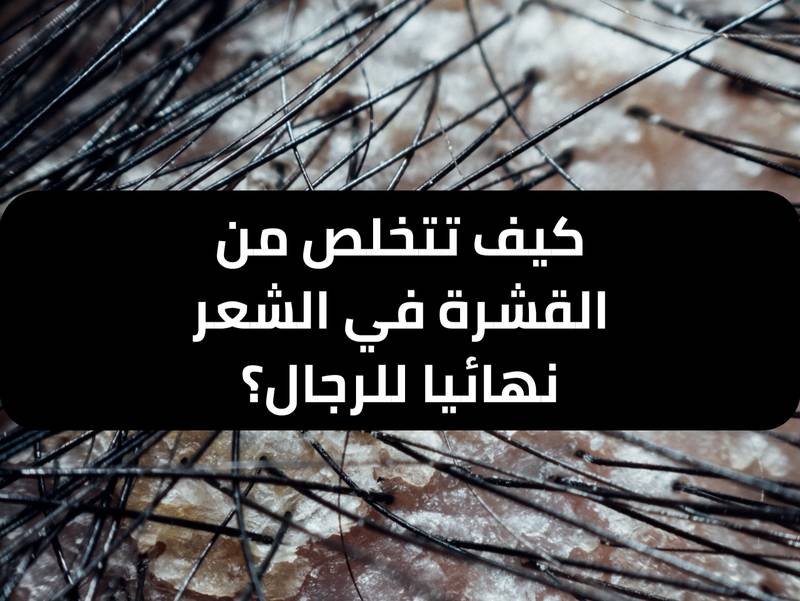 كيف تتخلص من القشرة في الشعر نهائيا للرجال ؟
